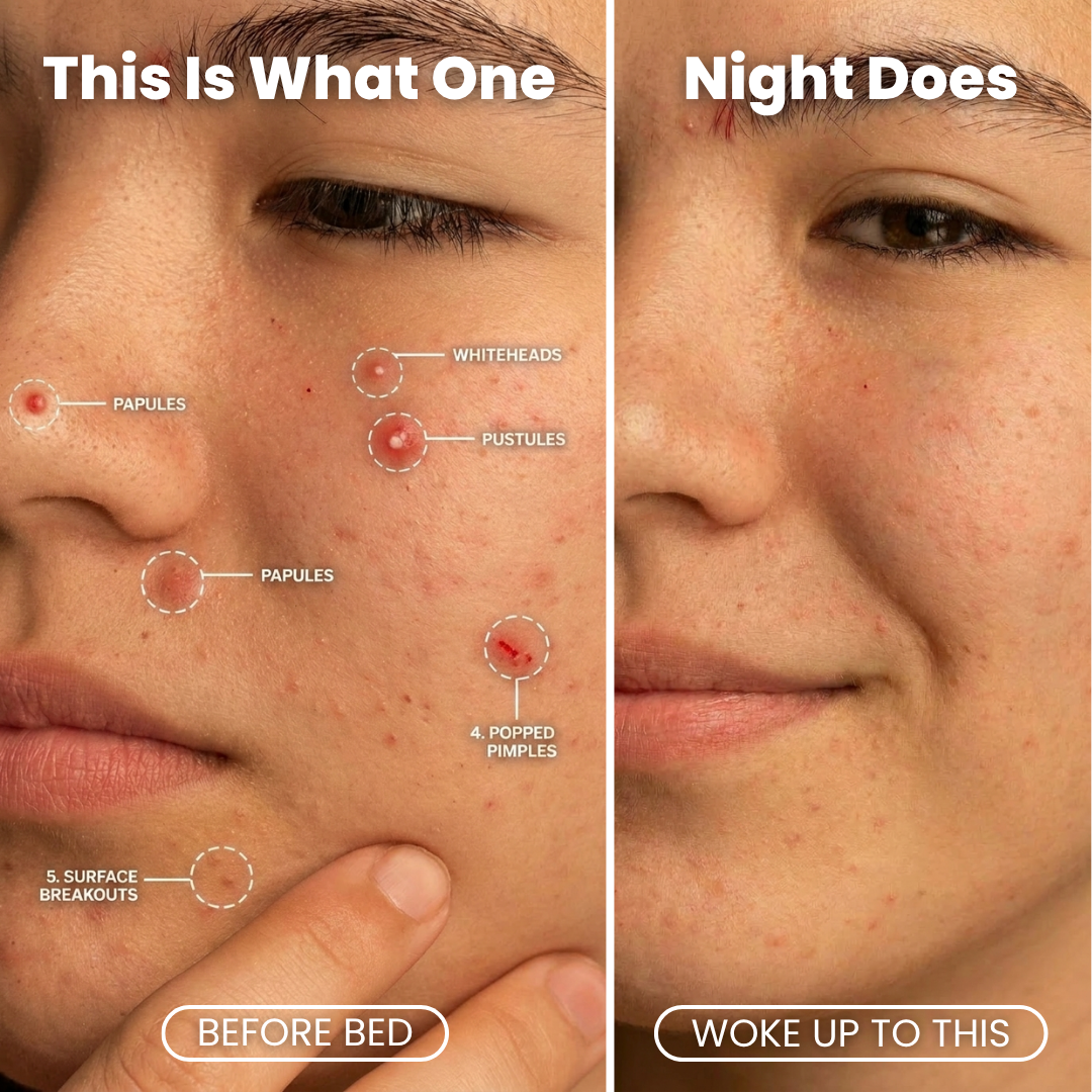 Overnight Pimple Patch